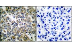 Immunohistochemistry analysis of paraffin-embedded human breast carcinoma tissue, using Keratin 14 Antibody.