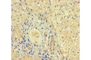 Immunohistochemistry of paraffin-embedded human liver cancer using ABIN7157448 at dilution of 1:100