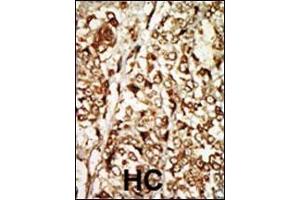 Formalin-fixed and paraffin-embedded human cancer tissue reacted with the primary antibody, which was peroxidase-conjugated to the secondary antibody, followed by AEC staining.