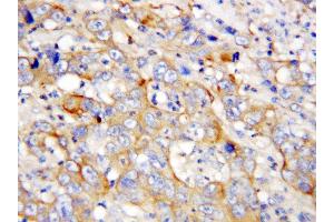 Anti-PF4 antibody, IHC(P) IHC(P): Human Lung Cancer Tissue (PF4 anticorps  (C-Term))