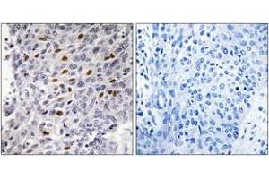 Immunohistochemistry analysis of paraffin-embedded human lung carcinoma tissue, using ATF1 (Ab-63) Antibody. (AFT1 anticorps  (AA 31-80))