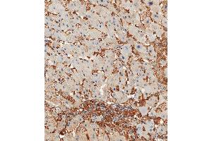 Immunohistochemical analysis of paraffin-embedded Human hepatocarcinoma tissue using A performed on the Leica® BOND RXm. (Annexin V anticorps  (N-Term))