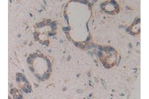 Detection of ICAM2 in Human Bile duct cancer Tissue using Polyclonal Antibody to Intercellular Adhesion Molecule 2 (ICAM2)