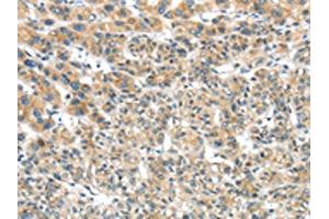 The image on the left is immunohistochemistry of paraffin-embedded Human liver cancer tissue using ABIN7131474(TRIM16 Antibody) at dilution 1/35, on the right is treated with fusion protein. (TRIM16 anticorps)