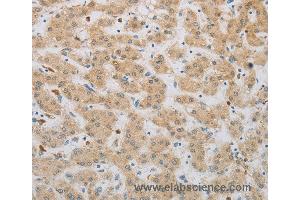Immunohistochemistry of Human gastric cancer using NBN Polyclonal Antibody at dilution of 1:50 (Nibrin anticorps)