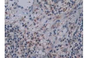 Detection of FAM3C in Human Skin cancer Tissue using Polyclonal Antibody to Family With Sequence Similarity 3, Member C (FAM3C) (FAM3C anticorps  (AA 25-227))