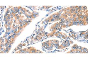 Immunohistochemistry of paraffin-embedded Human breast cancer using CD297 Polyclonal Antibody at dilution of 1:30