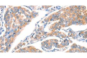 Immunohistochemistry of paraffin-embedded Human breast cancer using CD297 Polyclonal Antibody at dilution of 1:30 (ART4 anticorps)