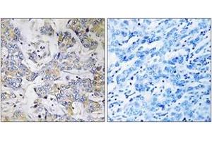 Immunohistochemistry analysis of paraffin-embedded human breast carcinoma tissue, using RPL37 Antibody. (RPL37 anticorps  (AA 21-70))