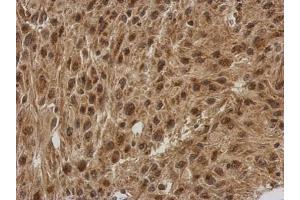 IHC-P Image Immunohistochemical analysis of paraffin-embedded U373 xenograft, using FGF13, antibody at 1:500 dilution.