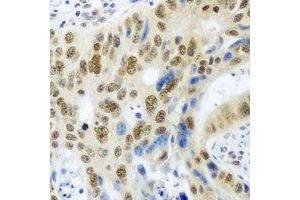 Immunohistochemical analysis of PSMA4 staining in human colon cancer formalin fixed paraffin embedded tissue section. (PSMA4 anticorps)