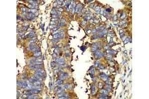 Immunohistochemistry of paraffin-embedded Human colon carcinoma using QARS Polyclonal Antibody at dilution of 1:100 (40x lens). (QARS anticorps)