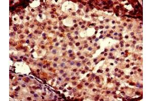 Immunohistochemistry of paraffin-embedded human breast cancer using ABIN7153026 at dilution of 1:100 (FOXC2 anticorps  (AA 24-294))
