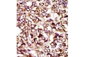 Formalin-fixed and paraffin-embedded human cancer tissue reacted with the primary antibody, which was peroxidase-conjugated to the secondary antibody, followed by DAB staining.