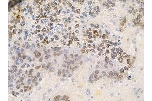 ABIN6256479 and ABIN6267655 at 1/100 staining human glioblastoma by IHC-P. (MED1 anticorps  (pThr1457))