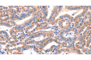 Immunohistochemistry of paraffin-embedded Human thyroid cancer tissue using AP1B1 Polyclonal Antibody at dilution 1:70 (AP1B1 anticorps)