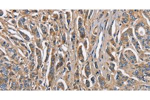 Immunohistochemistry of paraffin-embedded Human prostate cancer tissue using ABI3BP Polyclonal Antibody at dilution 1:60 (ABI3BP anticorps)