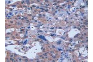 IHC-P analysis of Human Breast Cancer Tissue, with DAB staining. (Retinoic Acid Receptor alpha anticorps  (AA 68-173))