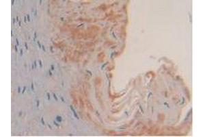 IHC-P analysis of Human Esophagus Cancer Tissue, with DAB staining. (SYK anticorps  (AA 374-635))