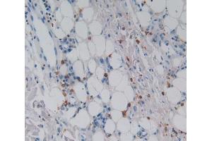 Used in DAB staining on fromalin fixed paraffin- embedded skin cancer tissue (CSF2RA anticorps  (AA 28-112))