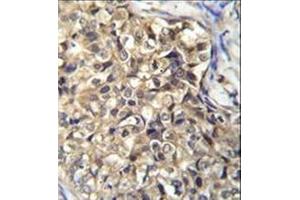 Immunohistochemistry analysis in formalin fixed and paraffin embedded human breast carcinoma reacted with KLHL35 Antibody (C-term) followed by peroxidase conjugation of the secondary antibody and DAB staining. (KLHL35 anticorps  (C-Term))