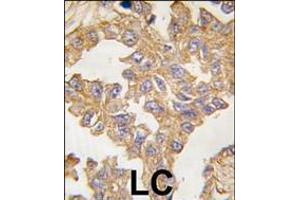 Formalin-fixed and paraffin-embedded human lung carcinoma tissue reacted with ACTB/ACTC antibody , which was peroxidase-conjugated to the secondary antibody, followed by DAB staining.