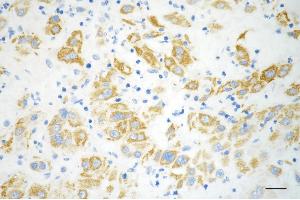 Immunohistochemistry was performed on paraffin-embedded human hepatocarcinoma using methylmalonyl-CoA mutase antibody (ABIN7799396), 1:200). (Recombinant MUT anticorps)