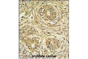SUPV3L1 Antibody (N-term) (ABIN1881857 and ABIN2843036) IHC analysis in formalin fixed and paraffin embedded prostate carcinoma followed by peroxidase conjugation of the secondary antibody and DAB staining.