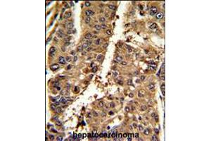 Formalin-fixed and paraffin-embedded mouse hepatocarcinoma reacted with PSME2 Antibody , which was peroxidase-conjugated to the secondary antibody, followed by DAB staining. (PSME2 anticorps  (C-Term))