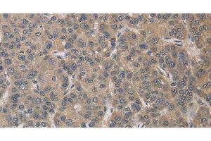 Immunohistochemistry of paraffin-embedded Human liver cancer tissue using ELOVL1 Polyclonal Antibody at dilution 1:30 (ELOVL1 anticorps)
