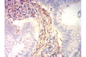 Immunohistochemical analysis of paraffin-embedded rectum cancer tissues using CNN3 mouse mAb with DAB staining. (CNN3 anticorps  (AA 26-130))
