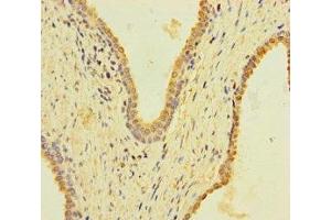 Immunohistochemistry of paraffin-embedded human prostate cancer using ABIN7157404 at dilution of 1:100 (KRT4 anticorps  (AA 1-200))