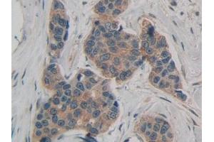 Detection of ATXN1 in Human Breast cancer Tissue using Polyclonal Antibody to Ataxin 1 (ATXN1) (Ataxin 1 anticorps  (AA 569-807))