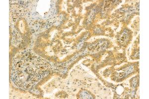 ABIN6259338 and ABIN6275436 at 1/100 staining Human lung cancer by IHC-P. (RAB3GAP2 anticorps  (Internal Region))
