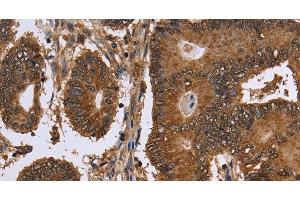 Immunohistochemistry of paraffin-embedded Human colon cancer tissue using FANCF Polyclonal Antibody at dilution 1:60 (FANCF anticorps)