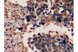 Detection of EGFR in Human Lung cancer Tissue using Polyclonal Antibody to Epidermal Growth Factor Receptor (EGFR)