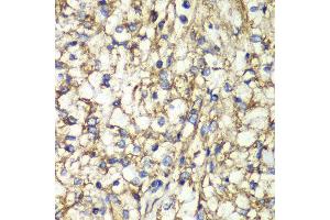 Immunohistochemistry of paraffin-embedded human kidney cancer using PTGES2 antibody at dilution of 1:100 (x40 lens). (PTGES2 anticorps)