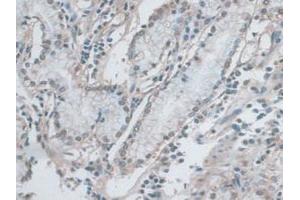 IHC-P analysis of Human Stomach Cancer Tissue, with DAB staining. (ERK1 anticorps  (AA 75-312))