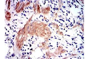Immunohistochemical analysis of paraffin-embedded stomach cancer tissues using GSTM1 mouse mAb with DAB staining.