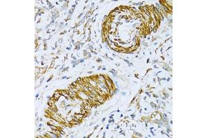 Immunohistochemistry of paraffin-embedded human gastric cancer using V antibody (ABIN6130774, ABIN6150046, ABIN6150047 and ABIN6224821) at dilution of 1:100 (40x lens).