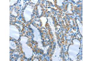 Immunohistochemical analysis of paraffin-embedded Human thyroid cancer tissue using at dilution 1/25. (ALPK1 anticorps  (C-Term))