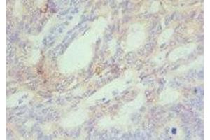 Immunohistochemistry of paraffin-embedded human colon cancer using ABIN7150954 at dilution of 1:100 (CBX4 anticorps  (AA 401-560))
