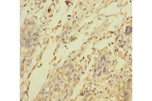 Immunohistochemistry of paraffin-embedded human pancreatic cancer using ABIN7144705 at dilution of 1:100 (C2orf49 anticorps  (AA 1-232))