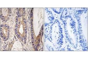 Immunohistochemistry analysis of paraffin-embedded human colon carcinoma tissue, using UPF1 Antibody. (RENT1/UPF1 anticorps  (AA 299-348))