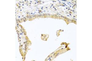 Immunohistochemistry of paraffin-embedded human lung cancer using PRKCA antibody (ABIN5970097) at dilution of 1/100 (40x lens). (PKC alpha anticorps  (C-Term))