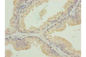 Immunohistochemistry of paraffin-embedded human prostate cancer using ABIN7173675 at dilution of 1:100
