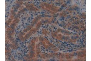 IHC-P analysis of Human Thyroid cancer Tissue, with DAB staining. (GPX4 anticorps  (AA 74-197))