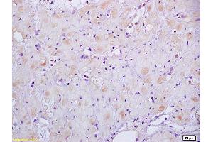 Formalin-fixed and paraffin embedded human gastric carcinoma labeled with Anti-HSD17B1 Polyclonal Antibody, Unconjugated (ABIN750178) at 1:200 followed by conjugation to the secondary antibody and DAB staining (HSD17B1 anticorps  (AA 21-120))