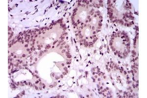 Immunohistochemical analysis of paraffin-embedded colon cancer tissues using MEF2C mouse mAb with DAB staining.