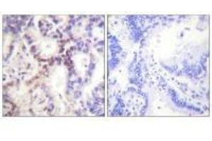 Immunohistochemical analysis of paraffin-embedded human lung carcinoma tissue using p15 INK antibody.